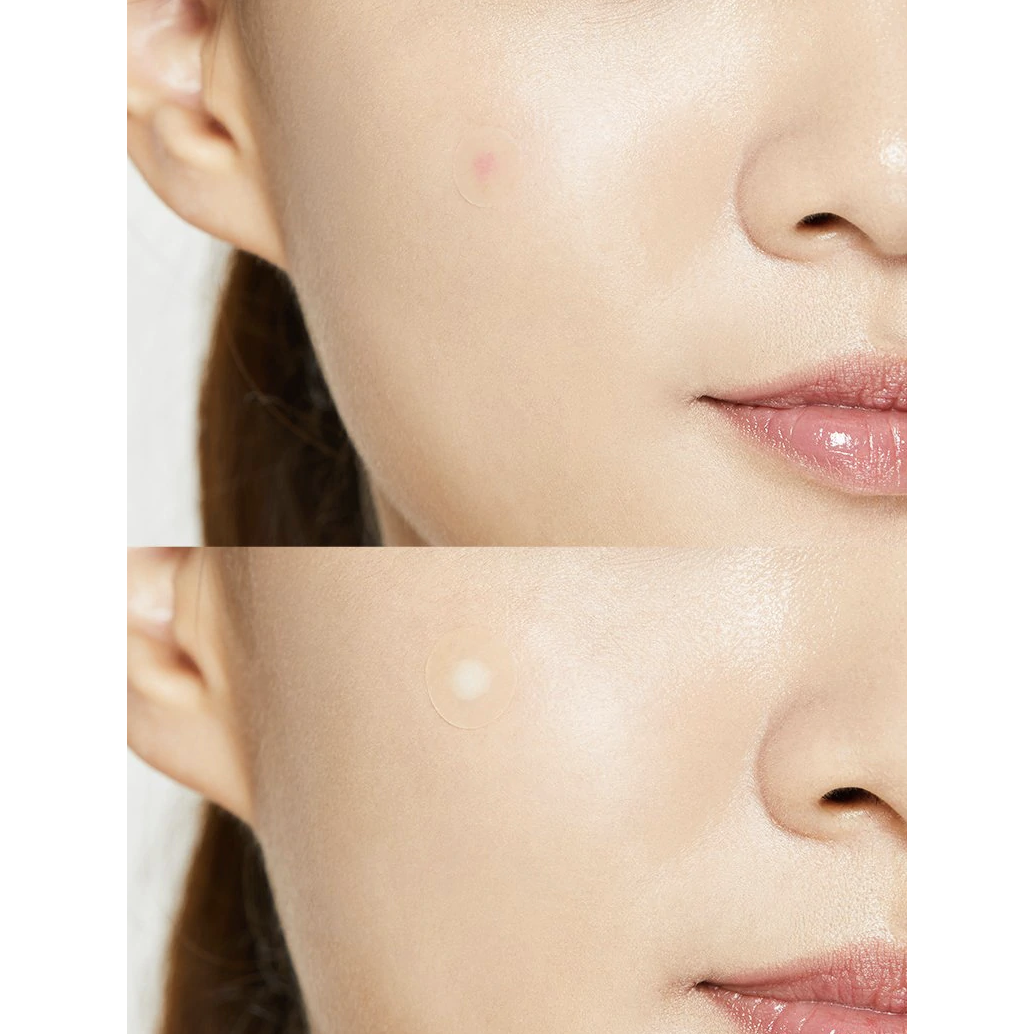 ACNE PIMPLE PATCH