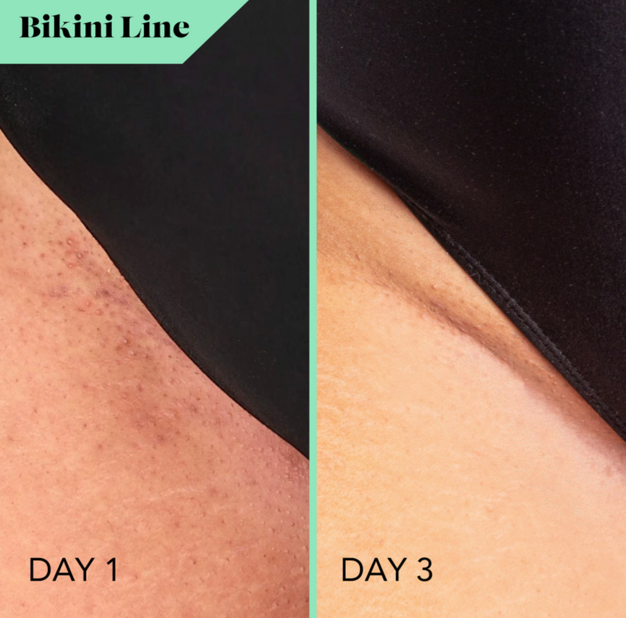Bikini & Body Bump Eraser